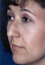 Rhinoplasty 02 Before 2