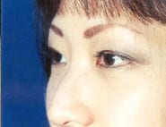 Eyelid Surgery 12 After 1