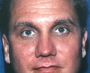 Buccal Fat Removal 02 After