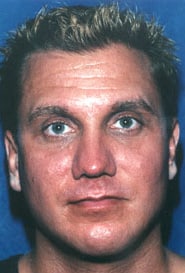 Buccal Fat Removal 02 After 1