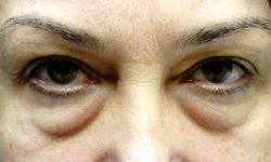 Eyelid Surgery 02 Before