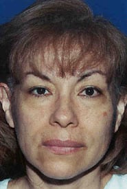 Facelift 11 Before 1