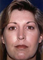 Rhinoplasty 10 After 1