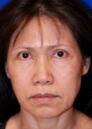 Facelift 01 Before 1