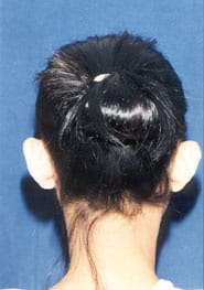 Otoplasty 01 Before 2