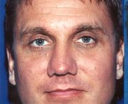 Buccal Fat Removal 02 Before