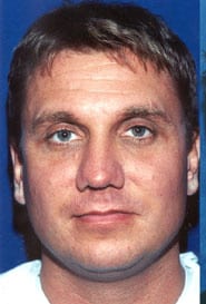 Buccal Fat Removal 02 Before 1