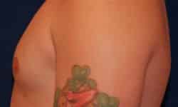 Gynecomastia 01 After