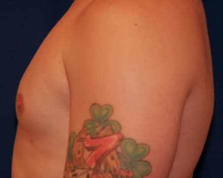 Gynecomastia 01 After 1