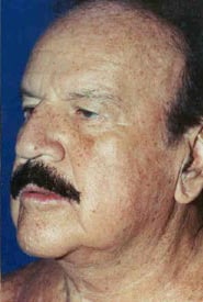 Neck Lift 03 After 2