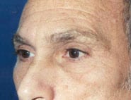 Eyelid Surgery 10 Before 2