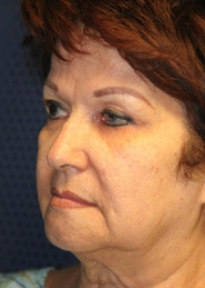 Facelift 04 Before 2