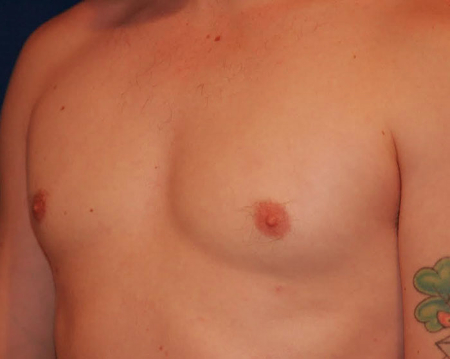 Gynecomastia 01 After 2
