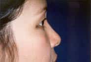 Eyelid Surgery 06 Before 3