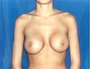 Breast Augmentation Revision 02 Before 1
