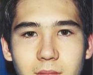 Rhinoplasty 01 After