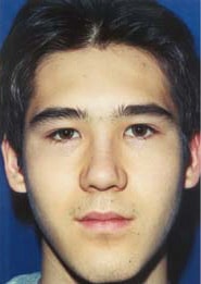 Rhinoplasty 01 After 1
