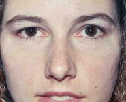 Rhinoplasty 08 After