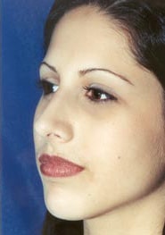 Rhinoplasty 07 After 2