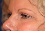 Eyelid Surgery 05 After 2