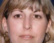 Rhinoplasty 10 Before