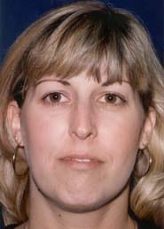 Rhinoplasty 10 Before 1