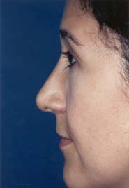 Rhinoplasty 02 After 3