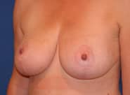 Breast Lift 04 After 2