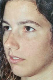 Rhinoplasty 08 Before 2