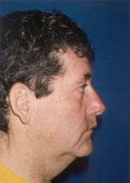 Facelift 08 Before 2