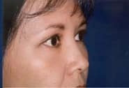 Eyelid Surgery 06 After 2
