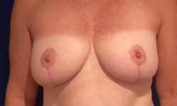 Breast Reduction 01 After