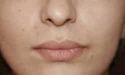 Lip Lift / Augmentation 01 Before
