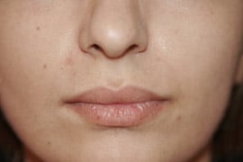 Lip Lift / Augmentation 01 Before 1