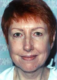 Facelift 07 Before 1