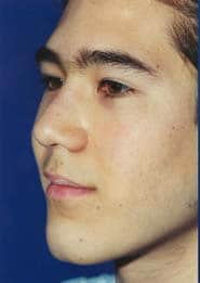 Rhinoplasty 01 Before 2