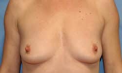 Breast Augmentation 09 Before