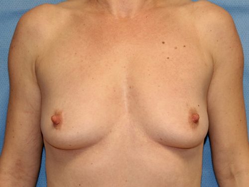Breast Augmentation 09 Before 1