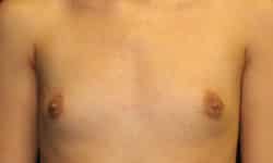 Breast Augmentation 07 Before