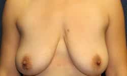Breast Augmentation 10 Before