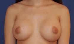 Breast Augmentation 07 After