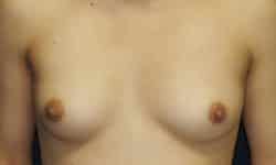 Breast Augmentation 05 Before