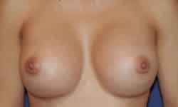 Breast Augmentation 05 After