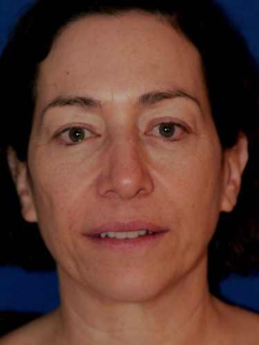 Neck Lift 01 Before 1