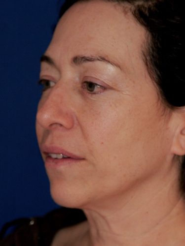 Neck Lift 01 Before 2