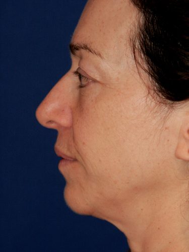 Neck Lift 01 Before 3