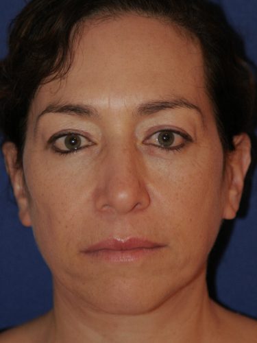 Neck Lift 01 After 1