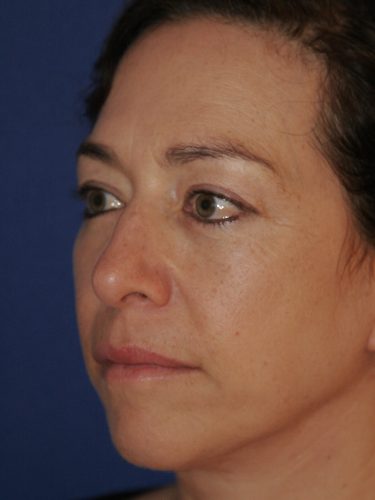 Neck Lift 01 After 2