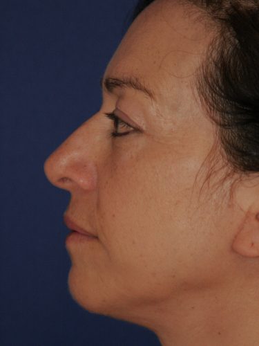 Neck Lift 01 After 3