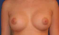 Breast Augmentation 08 After